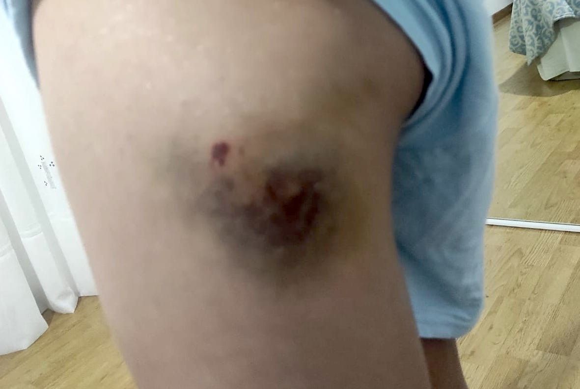 Consecuencias dun golpe cunha varanda nun pavillón de Marín
