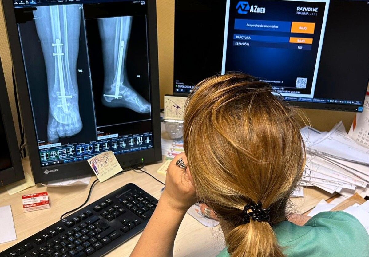 Primeros trabajos del sistema de IA para radiografías óseas simples en el área sanitaria