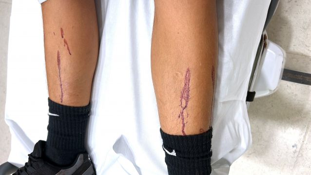 Pequenas feridas con sangue nas pernas do menor causadas polos cristais